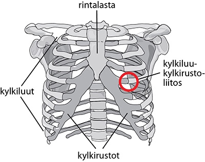 Tietzen Oireyhtym Ja Kostokondriitti Osteopaatti Olli Kuusisto Helsinki